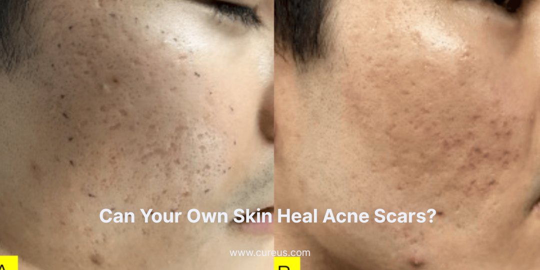 A new Cureus study shows how cultured epithelial sheet grafts significantly improved deep acne scars in just 3 months offering a promising regenerative, single-session solution.

Learn more: hubs.la/Q03wVPb70

#Cureus #AcneScars #Dermatology #ScarTreatment
