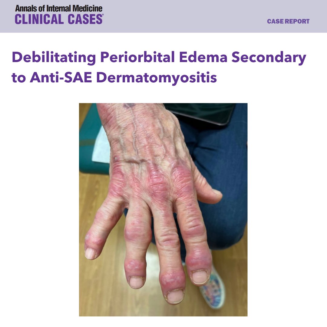 AnnalsofIMCC's tweet image. A case report describes a 65-year-old woman with amyopathic dermatomyositis (DM) with the presence of the small ubiquitin-like modifier activation enzyme 1 autoantibody presenting with severe, debilitating periorbital edema. bit.ly/3GMHzND @AHAScience #AHAJournals