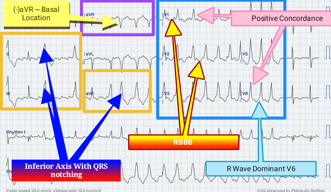 #ecg shows :

1. AFL in V1 and Lead 2
- atrial rate ~ 257bpm/CL 234msec
2. WCT with variable R-R interval; VT👇
- AV dissociation
- Fusions beat
- (+) Concordance
3. RBBB morphology
- No QRS transition
- (-)aVR
- Inferior Axis 
- QRS notching

🔺AFL with NSVT (AL Mitral Annulus)