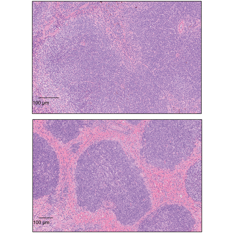 WEHI_research's tweet image. New research: NLRP3 inflammasome revealed as key driver in secondary HLH. Blocking two cell death proteins improved survival in mice. BET inhibitors may offer new treatment pathway. Published in Science Advances @ScienceMagazine
science.org/doi/10.1126/sc…