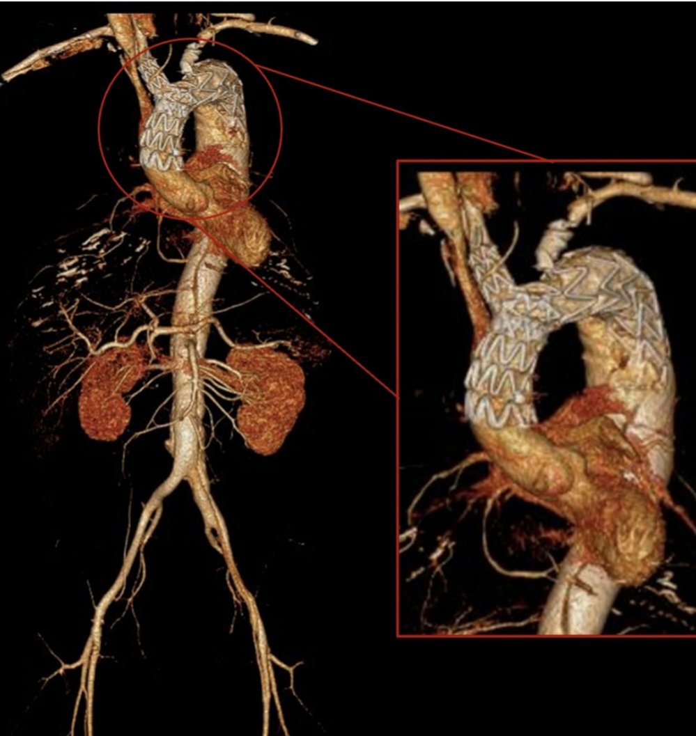 📢🌎✨ Proud to share our new paper on Latin America’s role in the aortic endovascular revolution. Innovation and resilience despite challenges.

It’s time for a Latin American Aortic Registry to drive progress together.

#AorticSurgery #Endovascular #LatinAmerica