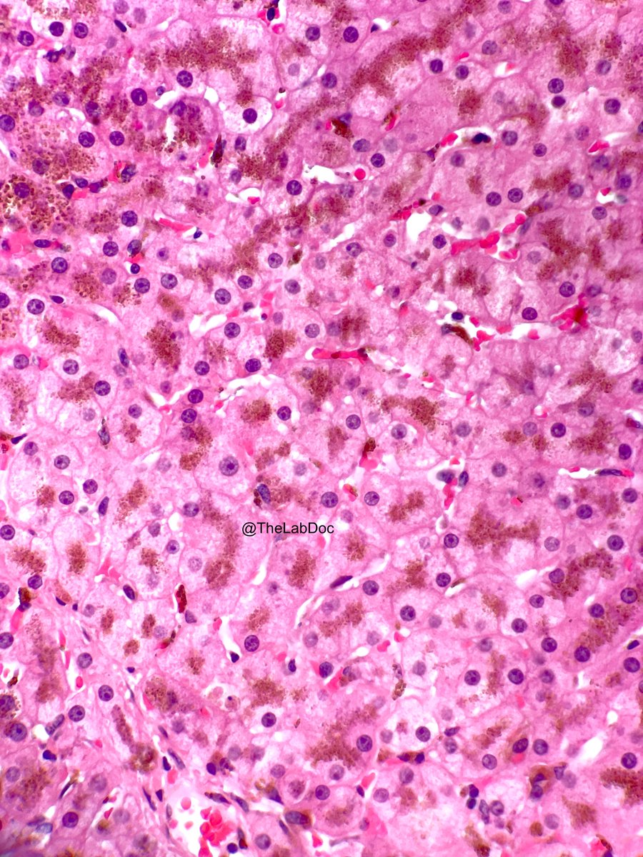 Ironclad: hepatic hemochromatosis
Coarse golden-brown iron granules (initially Zone 1 hepatocytes if primary/HH) ±hepatocyte damage. Periportal fibrosis (bridging) &gt; micronodular cirrhosis (seen on low power)
Iron should usually be confirmed w/ Prussian blue stain.
#PathTwitter