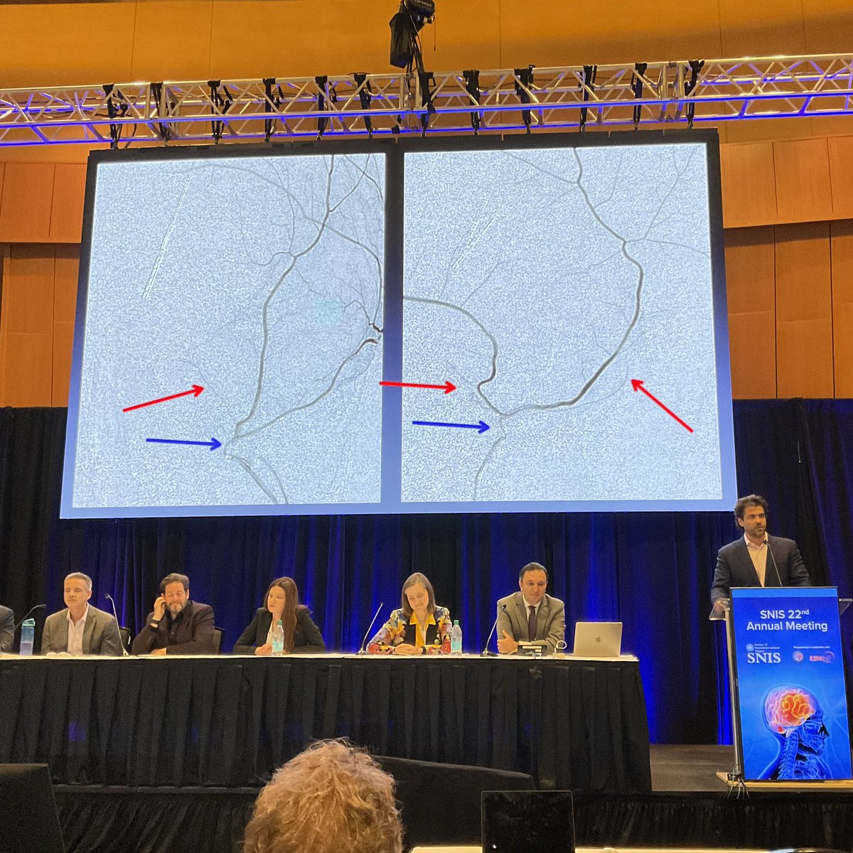 JNIS_BMJ's tweet photo. @MattAmansMD giving an engaging and interesting overview on the use of PVA particles for #MMAembolization for #subduralhematoma 🧠 #SNIS2025 @SNISInfo @SNIS_info @esmintsociety @cvsection @fcalbuquerque51 @dr_mchen @DanniDiestro @MattAmansMD @ducruetaf @MattFusco_MD @DrAltschul @cruzcerebri @niko_mou @aliyasiddiqui04 @MajidiShahram @UCSFNIR