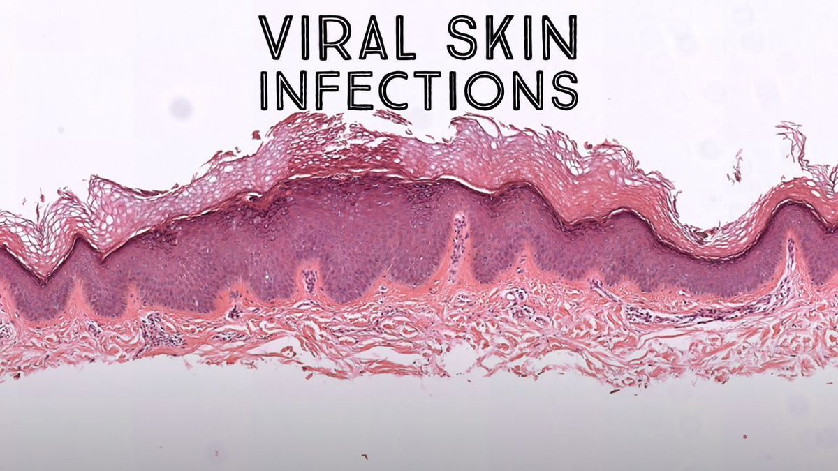 JMGardnerMD's tweet photo. Viral Infections of Skin (&amp; Mimics) Board Review. 
HSV/VZV, HPV, HHV-8, CMV, HFMD, EHK, pemphigus, Hailey-Hailey, &amp; more. 
Video: https://t.co/e6o51uq750
27 cases in 2 hours. Enjoy! 
#pathology #pathologists #pathTwitter #dermpath #dermatology #dermatologia #dermtwitter https://t.co/zSJzIXwkzd