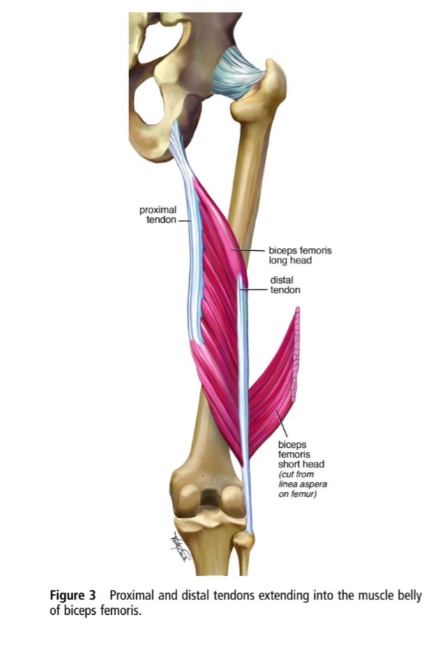 TheFootballPhys's tweet image. ⚽🤕 ‘Serious thigh muscle strains’: beware the intramuscular tendon which plays an important role in difficult hamstring and quadriceps muscle strains

bjsm.bmj.com/content/bjspor…