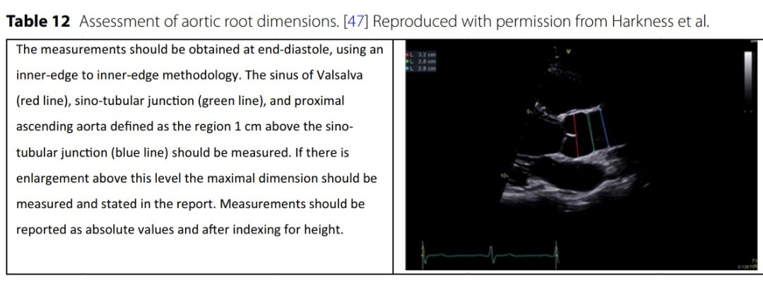javier20ch's tweet image. Evaluación Ecocardiográfica de la Aórta en la Ins. Aórtica. 🔎🫀💥
🔴Una evaluación integral de la Ao es esencial en el contexto de la Ins. Aórtica (IA), porque la dilatación Ao puede ser en sí misma la causa de la insuficiencia valvular (IA tipo 1).
🔴En ventana paraesternal eje…