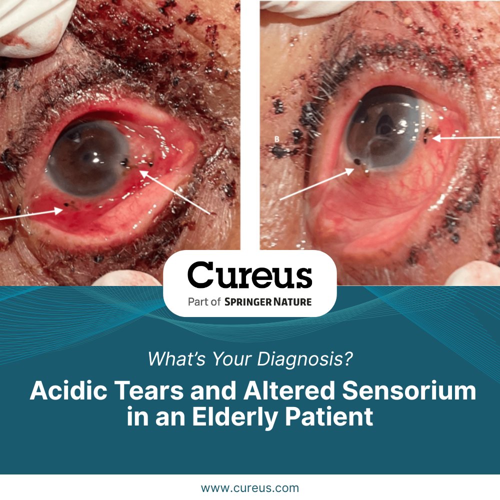 An elderly sadhu with severe eye irritation, acidic ocular pH &amp; signs of sepsis. What shocking finding did doctors uncover—and what's your diagnosis?

Submit your answer: hubs.la/Q03xbHdX0

#EyeCare #Sepsis #InfectiousDisease #OphthalmologyCase #CureusCases