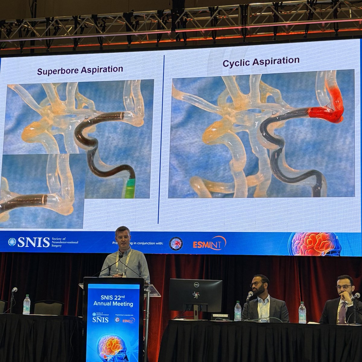 JNIS_BMJ's tweet photo. S. Fitzgerald showing in-vitro evaluation of the Supebore vs Conventional vs Cyclical Aspiration in EVT. Cyclical aspiration did not really improve first pass effect.  Superbore with the highest first pass effect. #SNIS2025 @SNISInfo @esmintsociety @cvsection @fcalbuquerque51 @dr_mchen @DanniDiestro @MattAmansMD @ducruetaf @MattFusco_MD @DrAltschul @cruzcerebri @niko_mou @aliyasiddiqui04 @Immon_original @LHMCNeuroInterv