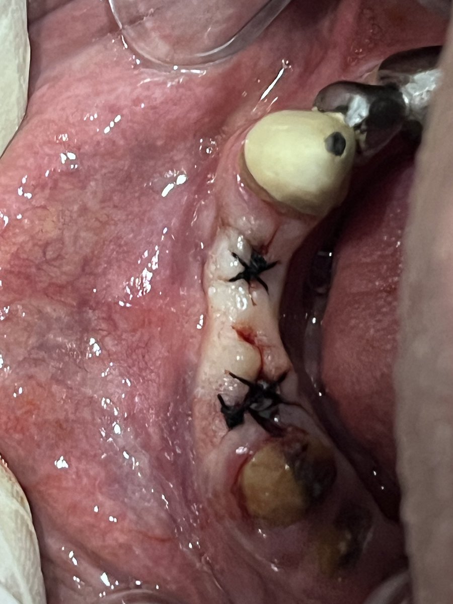 New learning (immediate implant)