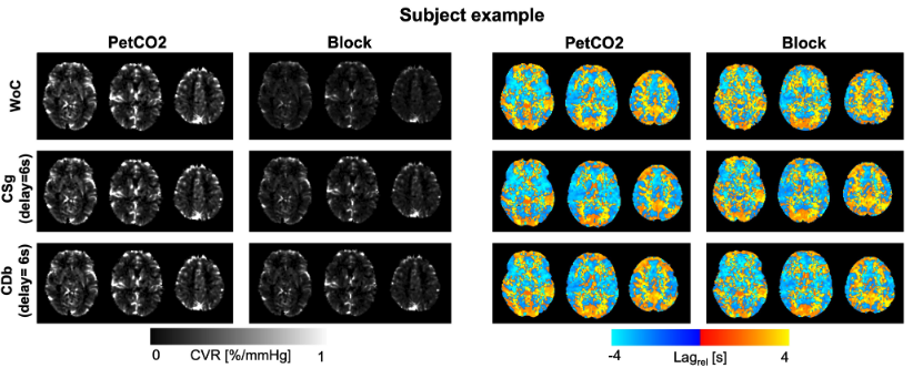 ImagingNeurosci's tweet image. New paper in Imaging Neuroscience by Catarina Domingos, Patrícia Figueiredo et al.:
Cerebrovascular reactivity mapping using breath-hold BOLD-fMRI: Comparison of signal models combined with voxelwise lag optimization
doi.org/10.1162/IMAG.a…