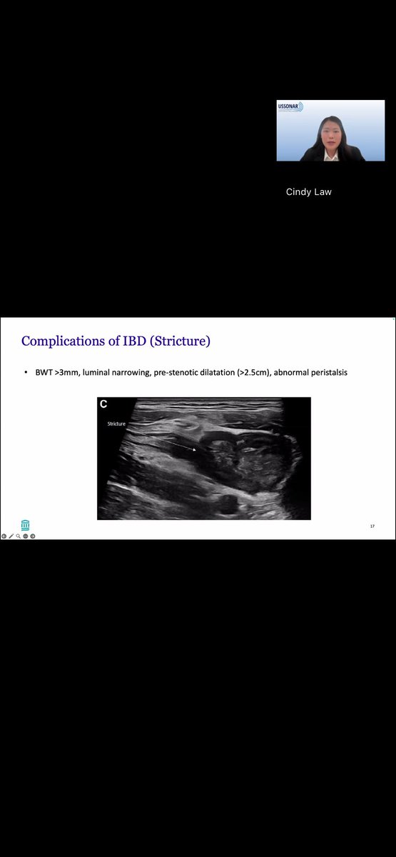 USSONAR_Rh's tweet image. Dr Law with a great overview of using intestinal ultrasound (IUS) as a quick, non-invasive way to evaluate for inflammatory bowel disease and identifying complicating factors of IBD including strictures, fistulas, abscesses and abnormal peristalsis
#IBD #Ultrasound #Gastro