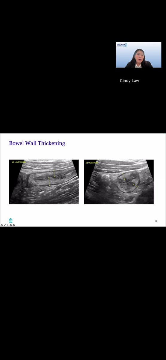 USSONAR_Rh's tweet image. Dr Law with a great overview of using intestinal ultrasound (IUS) as a quick, non-invasive way to evaluate for inflammatory bowel disease and identifying complicating factors of IBD including strictures, fistulas, abscesses and abnormal peristalsis
#IBD #Ultrasound #Gastro