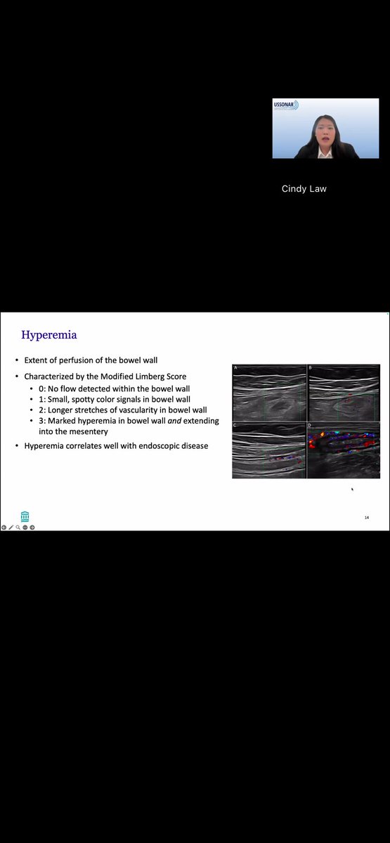 USSONAR_Rh's tweet image. Dr Law with a great overview of using intestinal ultrasound (IUS) as a quick, non-invasive way to evaluate for inflammatory bowel disease and identifying complicating factors of IBD including strictures, fistulas, abscesses and abnormal peristalsis
#IBD #Ultrasound #Gastro