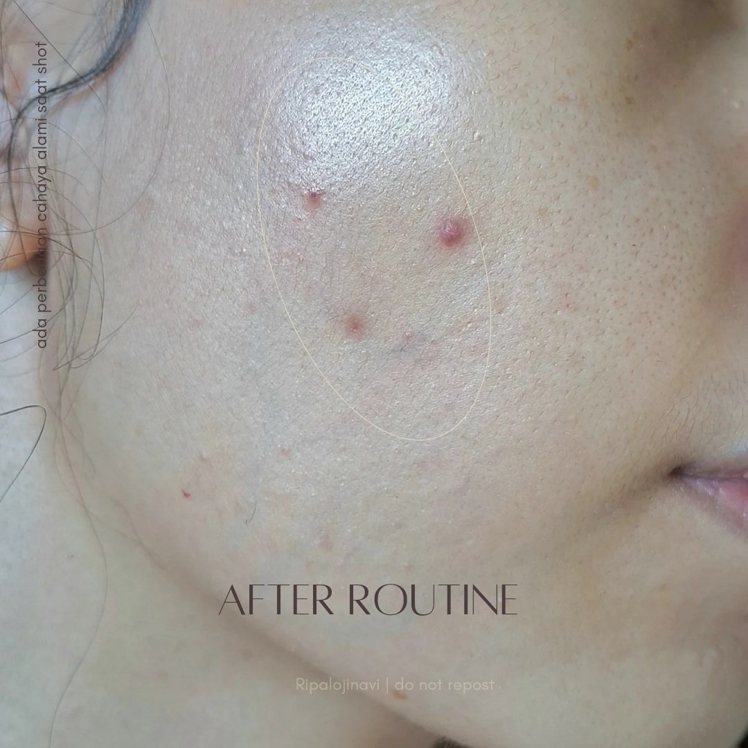 Ripalojinavi's tweet image. 😭 Baru dipake udah di-HM emak sendiri gegara &apos;cerahnya cepet ye, teh&apos;. Emang sik selain kulit jadi #glasskin, dipakenya enteng, lembap tapi velvety jadi gak hinyai, nyerahin dalem seminggu cukup keliatan. 

Kalau kamu ada darkspot karena #hyperpigmentation/ kusam cobain aja bes!