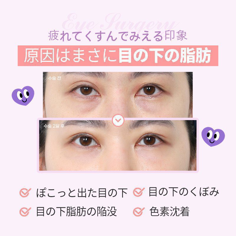 🎀ご予約・お問い合わせ🤍🎀
▷ lin.ee/khBNXZf

目の下のクマがないだけで
お顔の印象がガラッと変わる🫢💕

ジャストの目の下脂肪再配置で
脱‼️疲れ顔😮‼️

ジャストの目の下脂肪再配置は
🫢ここが特別🫢
☑︎隔膜強化でクマの再発を予防🐻
☑︎豊富な症例件数💉✨