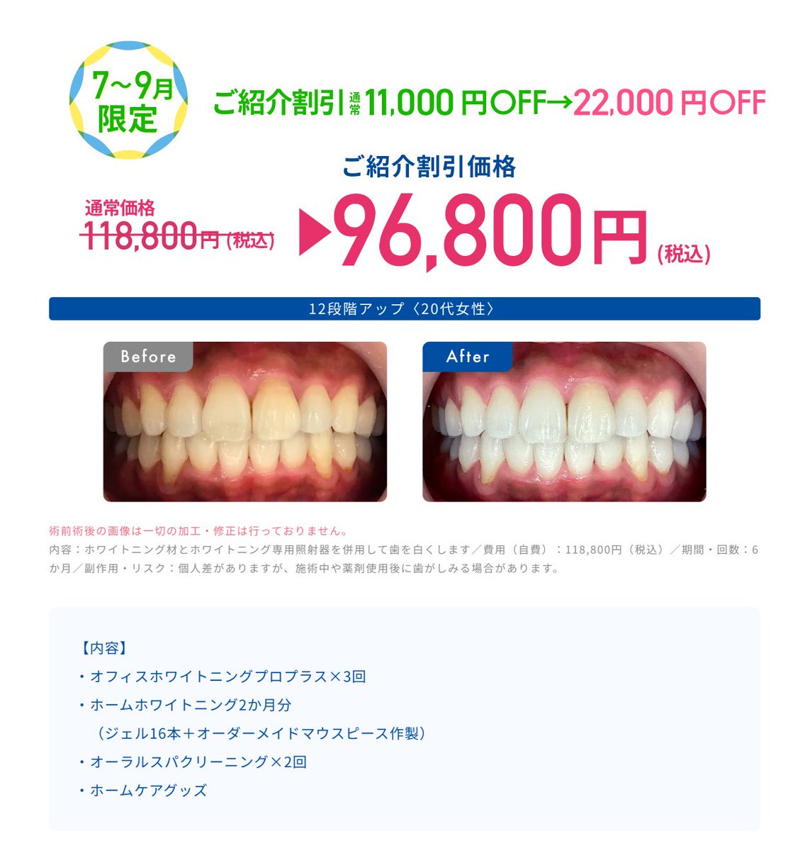 ホワイトエッセンス契約したんだけどやはり歯医者でやるホワイトニングが1番良い。最近セルフホワイトニング増えてるけど
あれ脱毛で言う光脱毛みたいな感じでそんな白くならない
歯医者のホワイトニングは医療脱毛みたいにちゃんと効果感じるよー
紹介予約なら2万円引きなる→rsv.whiteessence.com/reserve/reserv…