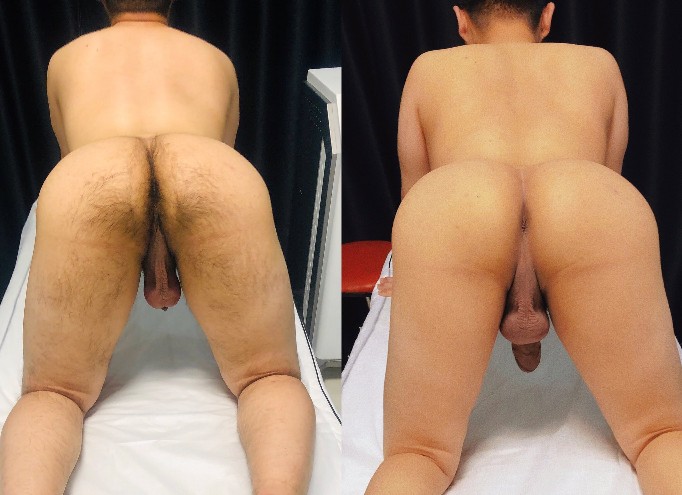 脱毛方法千千万
真正好用的当属冰点激光
冰点无痛永久脱毛🧊
能够在温和脱毛的同时可以嫩肤
而且脱完几次以后毛毛的生长速度会
变慢 变细 变毛发颜色变浅到不长毛
蓝颜男士，期待为您服务☺️☺️
预约微信：gaylanyan
预约QQ：215669812
公众号：shlanyan