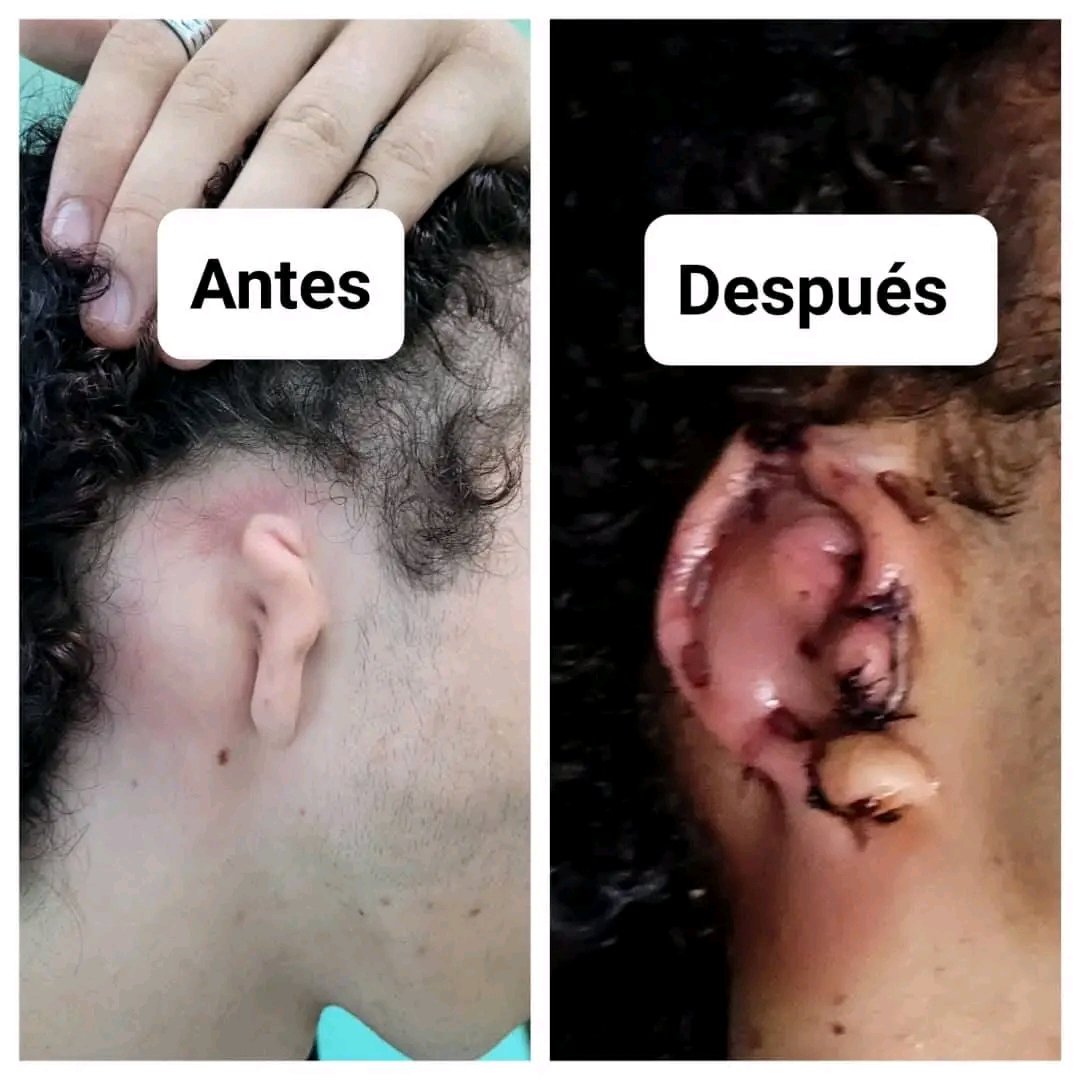 maybetanco1's tweet photo. Recuperacion favorable de paciente pediátrico 👦con primera cirugía reconstructiva de Microtia en #HolguínSí 
@radioangulo @MINSAPCuba @japortalmiranda #HolguínSí #CubaPorLaVida #HonorHolguinero #HéroesDeLaSalud #GenteQueSuma #CubaPorLaSalud https://t.co/OudCs6UgVn