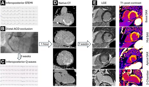 ehj_ed's tweet image. Profound iodine enhancement of the myocardium on a native CT scan one hour after invasive coronary angiography and revascularization. Read more in the @EHJ at doi.org/10.1093/eurhea… #CTScan #IodineEnhancement #Revascularization @Escardio @ESC_org