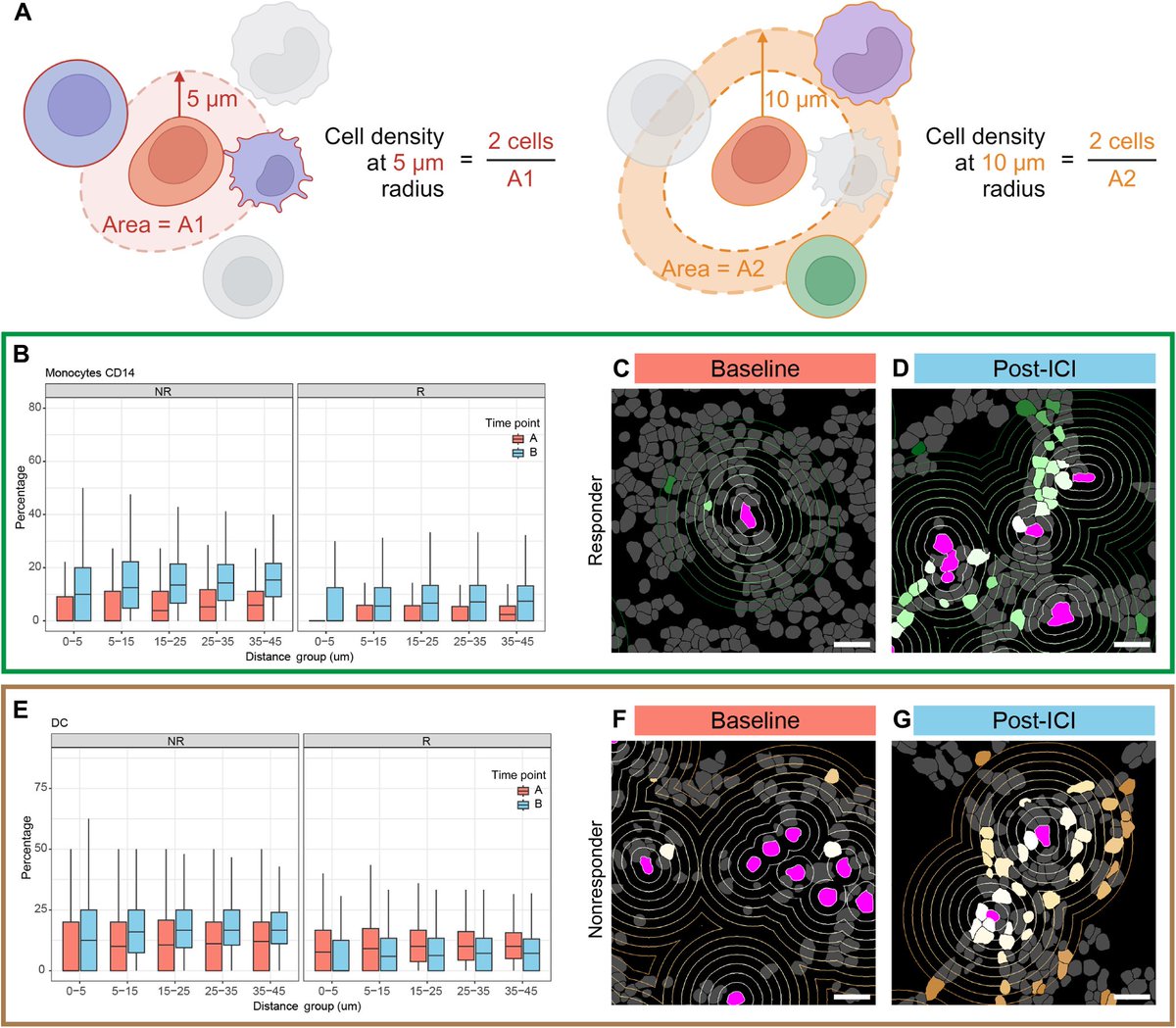AlcazerVincent's tweet image. Single-cell spatial transcriptomics reveals immunotherapy-driven bone marrow niche remodeling in AML | Science Advances science.org/doi/10.1126/sc…
