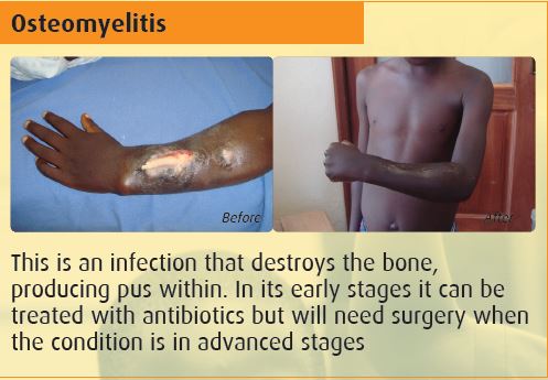 corsuhospital's tweet image. At CoRSU, Complex Wound Management is a vital service that can prevent disability.
Join the 2025 #corsuwalk & help us fund life-changing treatments for vulnerable children. Give them a 2nd chance at a bright future! #WalkForACause #SaveLives
Prevent disability, preserve hope!!