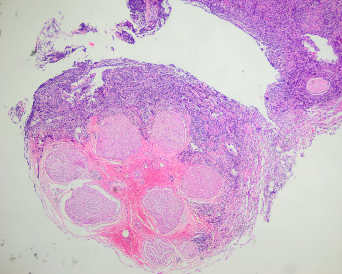 Part 2. Yes indeed! Primary cutaneous MARGINAL ZONE LYMPHOMA. A biopsy performed months earlier (at another hospital) in the contralateral wrist showed cutaneous and nerve involvement. She has been suffering cutaneous lesions for years.
