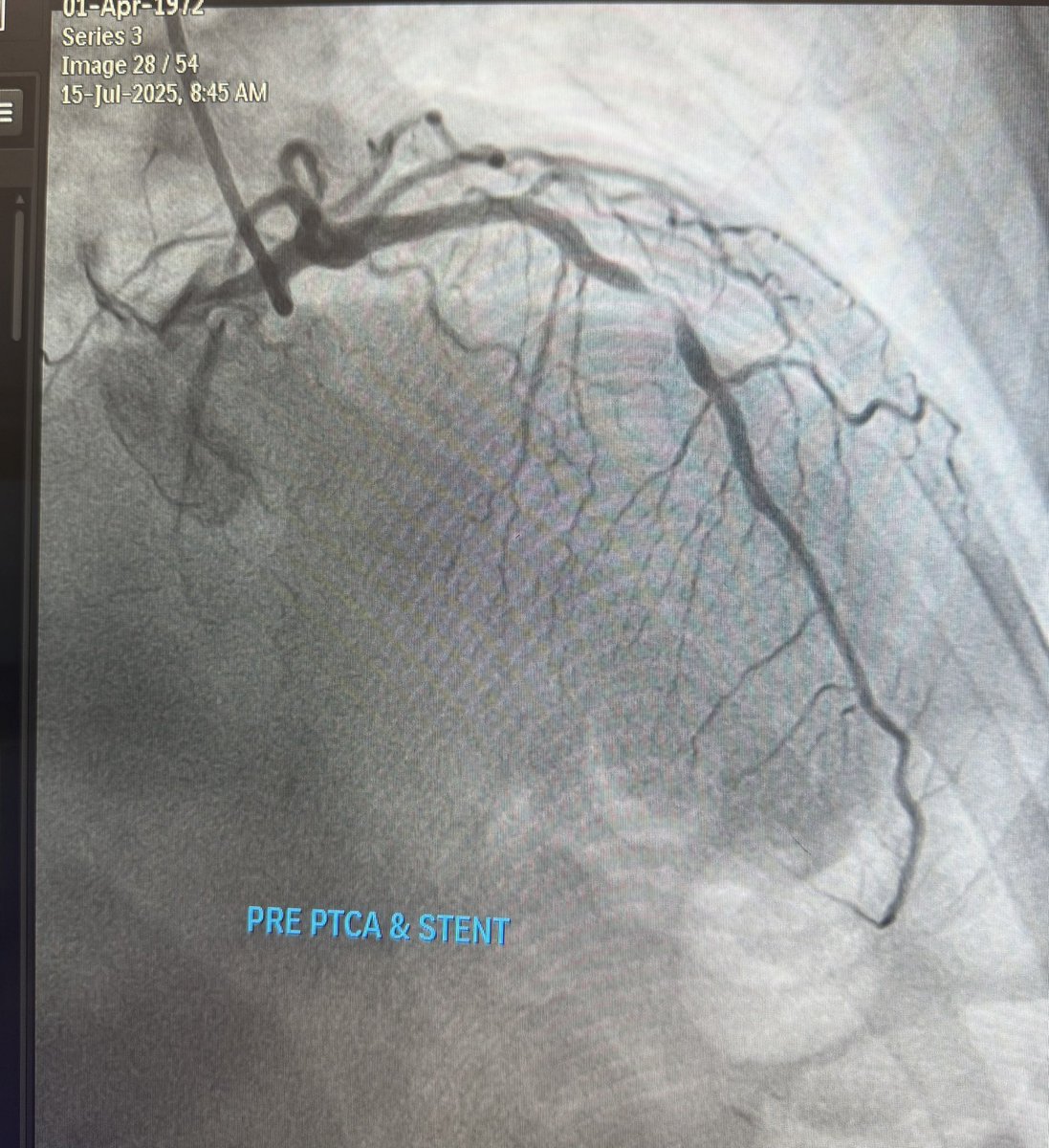 Dr Musa Mayayise (@musamayayise) on Twitter photo 60 years old diabetic hypertensive with CP. Culprit lesion on Angio. What causes inferior STD on this patient’s ECG?
<a href="/ecgrhythms/">Arnel Carmona</a>
<a href="/EcgOxford/">🫀EcgOxford</a>
@PMCardioBot
<a href="/RobertHermanMD/">Robert Herman, MD, PhD</a>
<a href="/The_Nanashi_O/">Nanashī🫀</a>
<a href="/smithECGBlog/">Stephen W. Smith</a>
<a href="/DidlakeDW/">David Didlake</a>
<a href="/ecgandrhythmRoe/">Dr. Andreas Roeschl</a>
<a href="/DaveRichley/">Dave Richley</a>
<a href="/ShaojieChen1/">Shaojie Chen</a>
<a href="/Ecgloverr/">Pedram</a> 60 years old diabetic hypertensive with CP. Culprit lesion on Angio. What causes inferior STD on this patient’s ECG?
<a href="/ecgrhythms/">Arnel Carmona</a>
<a href="/EcgOxford/">🫀EcgOxford</a>
@PMCardioBot
<a href="/RobertHermanMD/">Robert Herman, MD, PhD</a>
<a href="/The_Nanashi_O/">Nanashī🫀</a>
<a href="/smithECGBlog/">Stephen W. Smith</a>
<a href="/DidlakeDW/">David Didlake</a>
<a href="/ecgandrhythmRoe/">Dr. Andreas Roeschl</a>
<a href="/DaveRichley/">Dave Richley</a>
<a href="/ShaojieChen1/">Shaojie Chen</a>
<a href="/Ecgloverr/">Pedram</a>