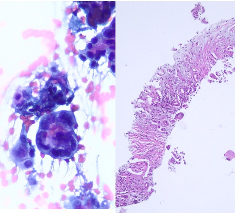 Lola Lozano (@mdlozanoe) on Twitter photo Cytohistological correlations using EUS-guided FNAC/FNAB: PDAC
" The power of small samples" <a href="/IACytology/">International Academy Cytology</a> <a href="/AshishC97225686/">Ashish.Chandra</a> <a href="/CarmenGomezMD/">Carmen Gomez-Fernandez, MD</a> <a href="/mtsiddi/">Momin Siddiqui</a> <a href="/SECitologia/">Sociedad Española de Citología</a> <a href="/SEAP_IAP/">SEAP-IAP</a> <a href="/CytologyEFCS/">EFCS</a> <a href="/EfcsYoung/">Young EFCS</a> <a href="/CytopathologyJ/">Cytopathology</a> <a href="/MauroSaieg/">Mauro Saieg, MD, PhD, FIAC</a> <a href="/Sinchita_Roy/">Sinchita Roy MD PhD</a> Cytohistological correlations using EUS-guided FNAC/FNAB: PDAC
" The power of small samples" <a href="/IACytology/">International Academy Cytology</a> <a href="/AshishC97225686/">Ashish.Chandra</a> <a href="/CarmenGomezMD/">Carmen Gomez-Fernandez, MD</a> <a href="/mtsiddi/">Momin Siddiqui</a> <a href="/SECitologia/">Sociedad Española de Citología</a> <a href="/SEAP_IAP/">SEAP-IAP</a> <a href="/CytologyEFCS/">EFCS</a> <a href="/EfcsYoung/">Young EFCS</a> <a href="/CytopathologyJ/">Cytopathology</a> <a href="/MauroSaieg/">Mauro Saieg, MD, PhD, FIAC</a> <a href="/Sinchita_Roy/">Sinchita Roy MD PhD</a>