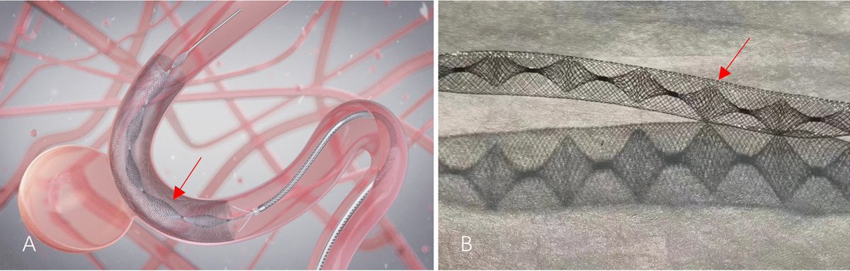 CVIR_Journal's tweet image. Read now in CVIR 👇
Lattice Flow Diverter for the Treatment of Unruptured Intracranial Aneurysms: A Retrospective Study
link.springer.com/article/10.100…
