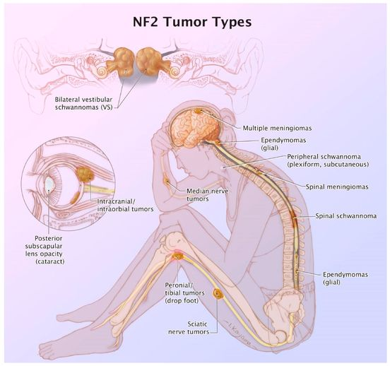 nf2biosolution1's tweet image. Another infographic to start the knowledge this week.
Thats NF2, all those tumour types
#endNF2 #NF2awareness #neurofibromatosistype2
#NF2support #nf2 #nf2family #nf2warrior #LetstalkNF2