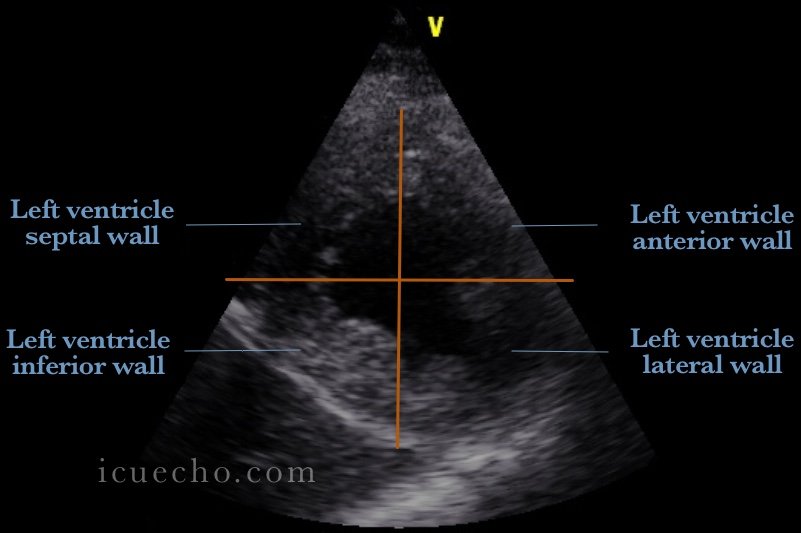 Left ventricular segmentation (PSSA) view:

I remember them like:
》In Basal &amp; Mid:
▪︎ Anterior has two arms: Antroseptal &amp; Antrolateral.
▪︎ Inferior has two arms: Inferoseptal &amp; inferolateral.

》Apical: Septal, Anterior, lateral, Inferior.

How do you remember them?🤔