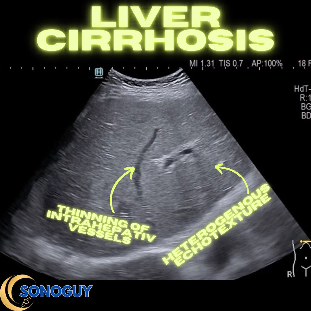 Liver Cirrhosis: What the #Ultrasound Shows Before the Complications Do📸👨‍⚕️
🔹 Coarse echotexture
🔹 Irregular surface
🔹 Lobe size changes
🔹 Enlarged caudate
🔹 Portal vein still flowing?
Do you routinely check these in your liver scans?
More in the comments ⬇️
#FOAMed