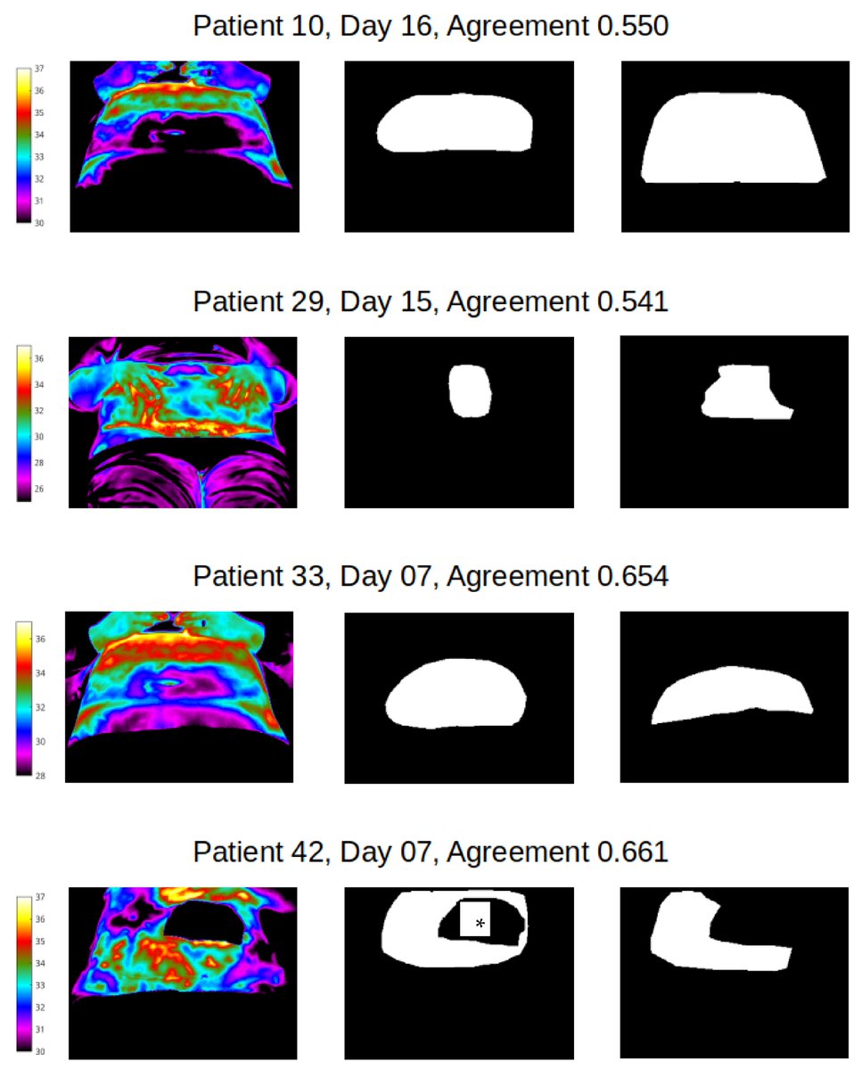 Applsci's tweet image. 🔥 Read our Paper
📚 #Segmentation Agreement and AI-Based #FeatureExtraction of Cutaneous #InfraredImages of the Obese Abdomen after #CaesareanSection: Results from a Single Training Session
🔗 mdpi.com/2076-3417/13/6…
👨🔬 by Charmaine Childs, Harriet Nwaizu, Oana Voloaca and Alex…