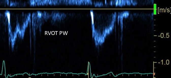 A patient with precapillary pulmonary hypertension and atrial fibrillation. RVOT sampling shown. Why is mid-systolic notching variable?