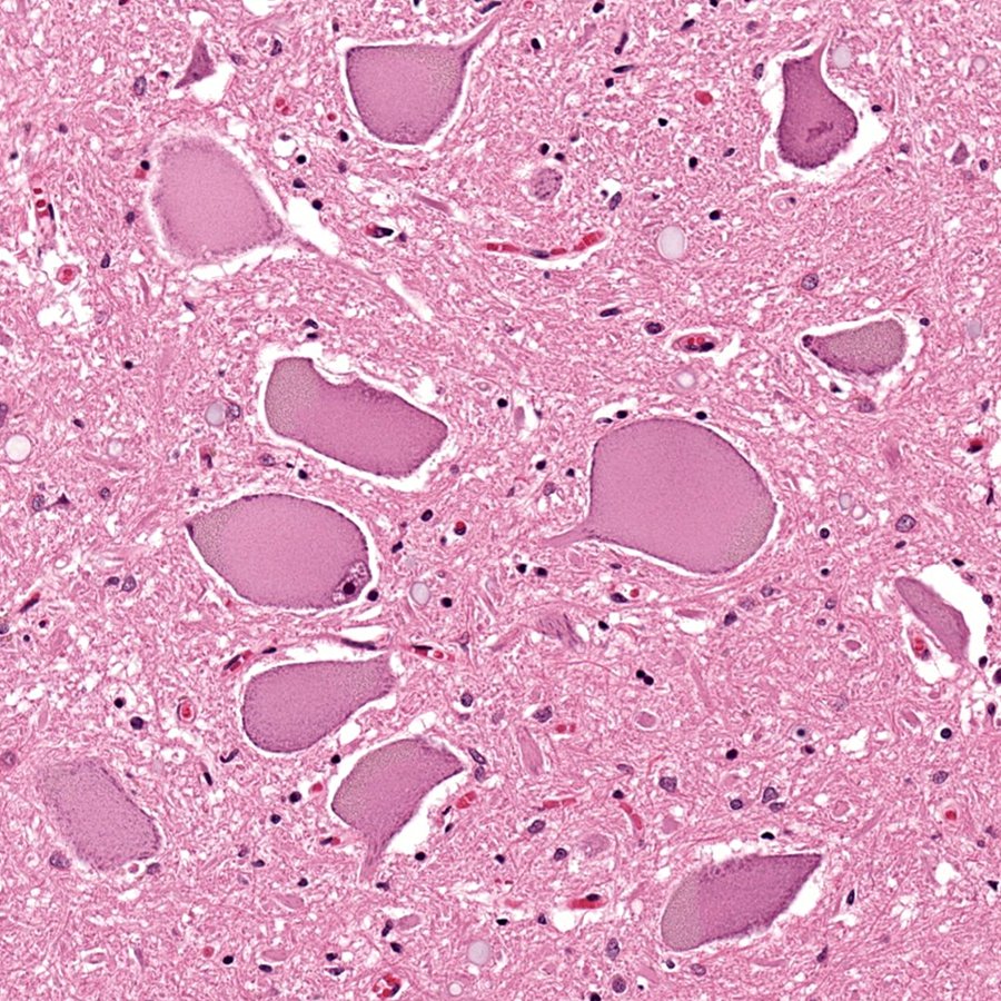 CraigHorbinski's tweet image. #neuropath isn&apos;t just tumors, it&apos;s a lot of things. Like trauma. Here&apos;s a cluster of anterior horn spinal neurons undergoing central chromatolysis in response to axonal injury, wherein the neurons upregulate protein synthesis to facilitate axon regrowth. #PathTwitter #pathology