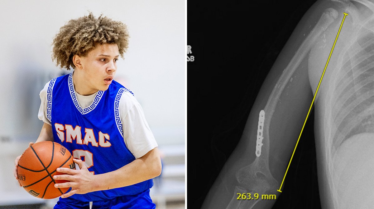 CleClinicNews's tweet image. When he was 6 years old, Myles underwent a reconstructive surgery where surgeons replaced his diseased arm bone with a transplanted leg bone to treat his bone cancer.
Now 14 years old, his doctors marvel at his athleticism. #SarcomaAwarenessMonth
More: cle.clinic/3YGKygm
