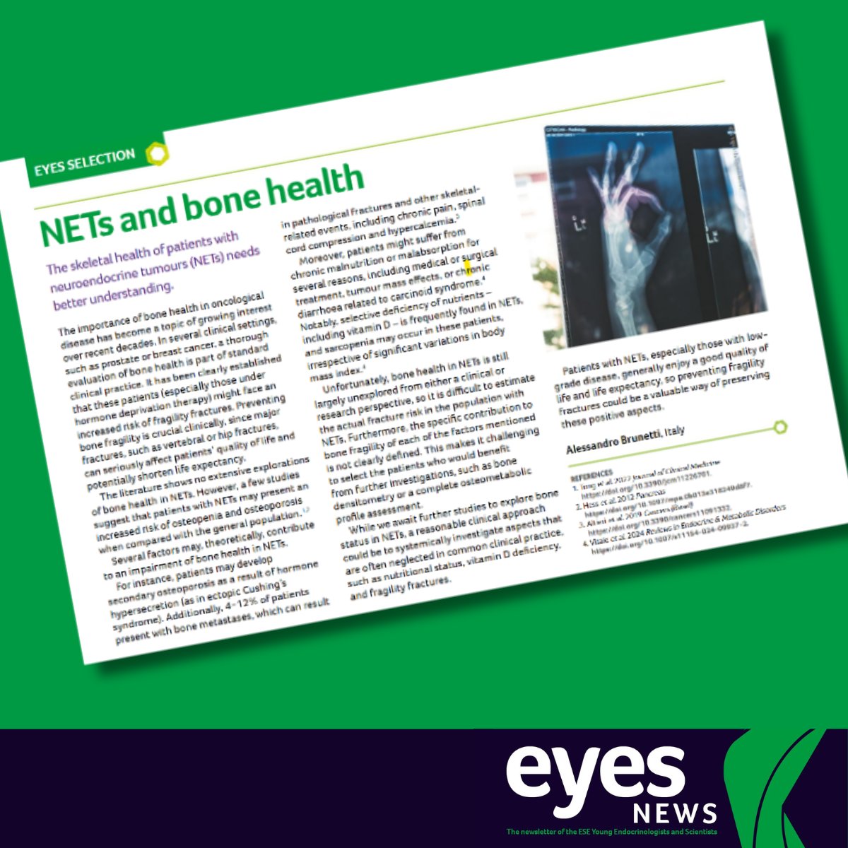 ESEndocrinology's tweet image. Neuroendocrine tumours and bone health by Alessandro Brunetti 👉 issuu.com/victoria.withy…
The latest issue of @EYEScientists News takes a look at the chaotic world of neuroendocrine tumours (NETs). Full issue 👉 ow.ly/qPVB50WcZtz
