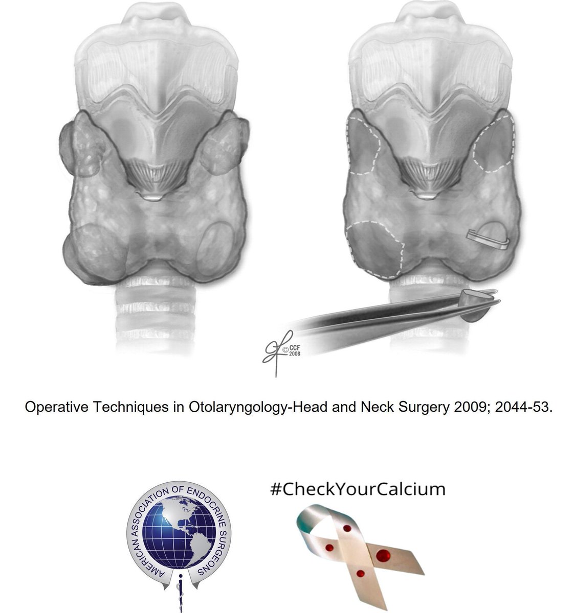 TheAAES's tweet image. Some patients with primary hyperparathyroidism have all 4 parathyroid glands enlarged—this is called hyperplasia.
In these cases, surgeons often perform a subtotal parathyroidectomy, removing 3.5 glands and leaving just enough tissue to keep calcium levels normal.
#PAM2025