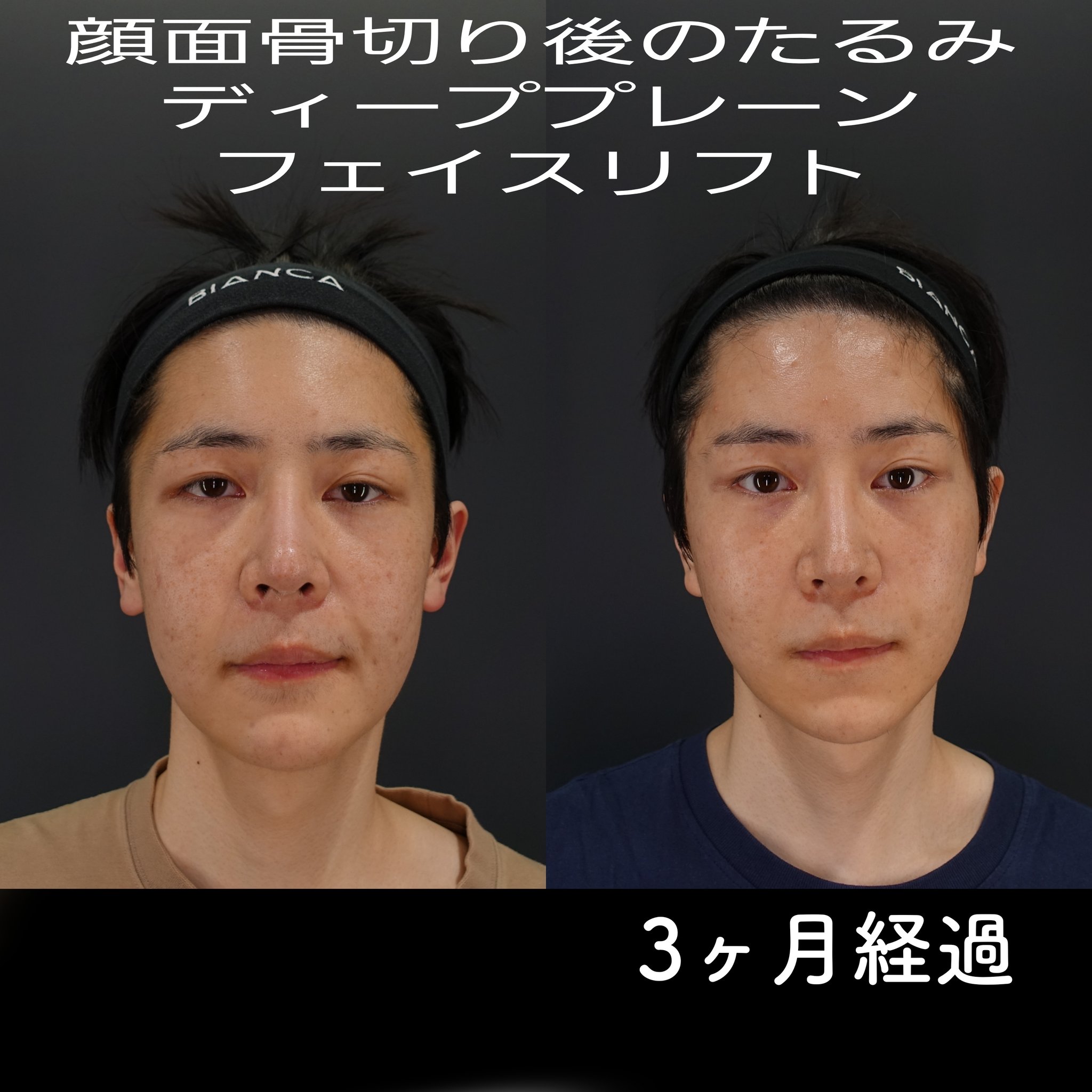 ビアンカクリニック　B.THE MASK B.THEMASK30P】BIANCACLINICから誕生したB.シリーズ人気NO1の