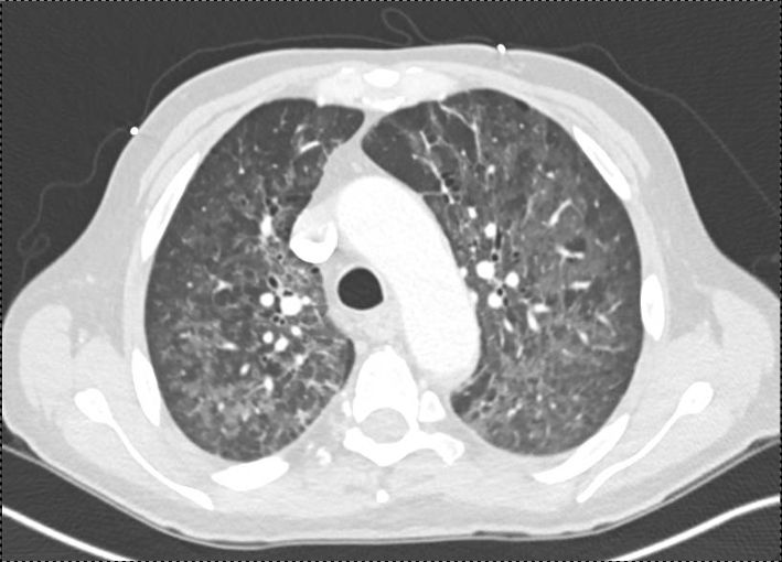 PulmPEEPs's tweet image. Check out the video of our UVA Case Files! Available on YouTube and VuMedi!
youtu.be/_Wf4PGH7Hmo