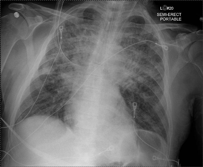 PulmPEEPs's tweet image. Check out the video of our UVA Case Files! Available on YouTube and VuMedi!
youtu.be/_Wf4PGH7Hmo