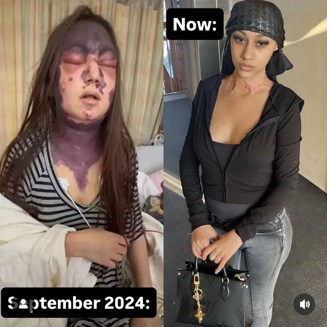 ConsChrisNews's tweet image. Do you remember Alexis Lorenze, the young lady who was intentionally given multiple vaccines at once and suffered severe injuries due to it.
Her journey to recovery has been extremely hard to watch.
But she is looking amazing now!
We will NEVER forgive or forget!