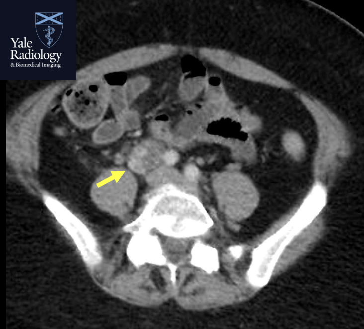 Mahan_Mathur's tweet image. TEACHING COD: indeterminate retroperitoneal mass; this one turned out to be an anastomosing hemangioma! #FOAMrad #FOAMed #radres #medstudent #radiology @RadDiscord #MedTwitter @YaleRadRes @Yale_IR
