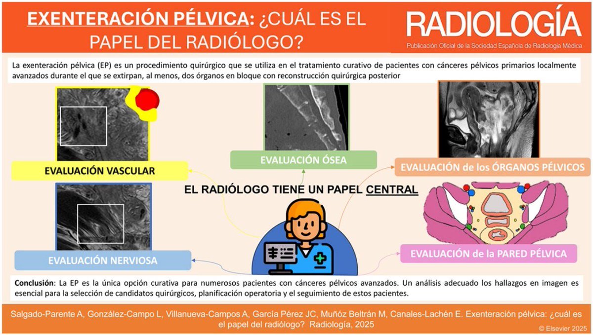 Alba Salgado Parente (@albasalpar) on Twitter photo 🔍 La exenteración pélvica es una cirugía de alta complejidad que exige una planificación rigurosa
➡️ Revisamos en <a href="/RevistaRADIOLO2/">@RevistaRADIOLOGIA</a> el papel esencial del radiólogo en la selección prequirúrgica, la evaluación locorregional y el seguimiento
📝 authors.elsevier.com/a/1lK037iMD7jqi 🔍 La exenteración pélvica es una cirugía de alta complejidad que exige una planificación rigurosa
➡️ Revisamos en <a href="/RevistaRADIOLO2/">@RevistaRADIOLOGIA</a> el papel esencial del radiólogo en la selección prequirúrgica, la evaluación locorregional y el seguimiento
📝 authors.elsevier.com/a/1lK037iMD7jqi