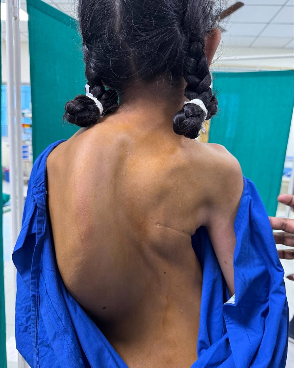 NNUH's tweet image. In March Mr Girish Swamy, Consultant Orthopaedic Spinal Surgeon, put together a team of specialists to operate on patients with severe scoliosis in Kolkata.
All the patients were charity cases who, without the interventions, would not have had access to these complex surgeries.
