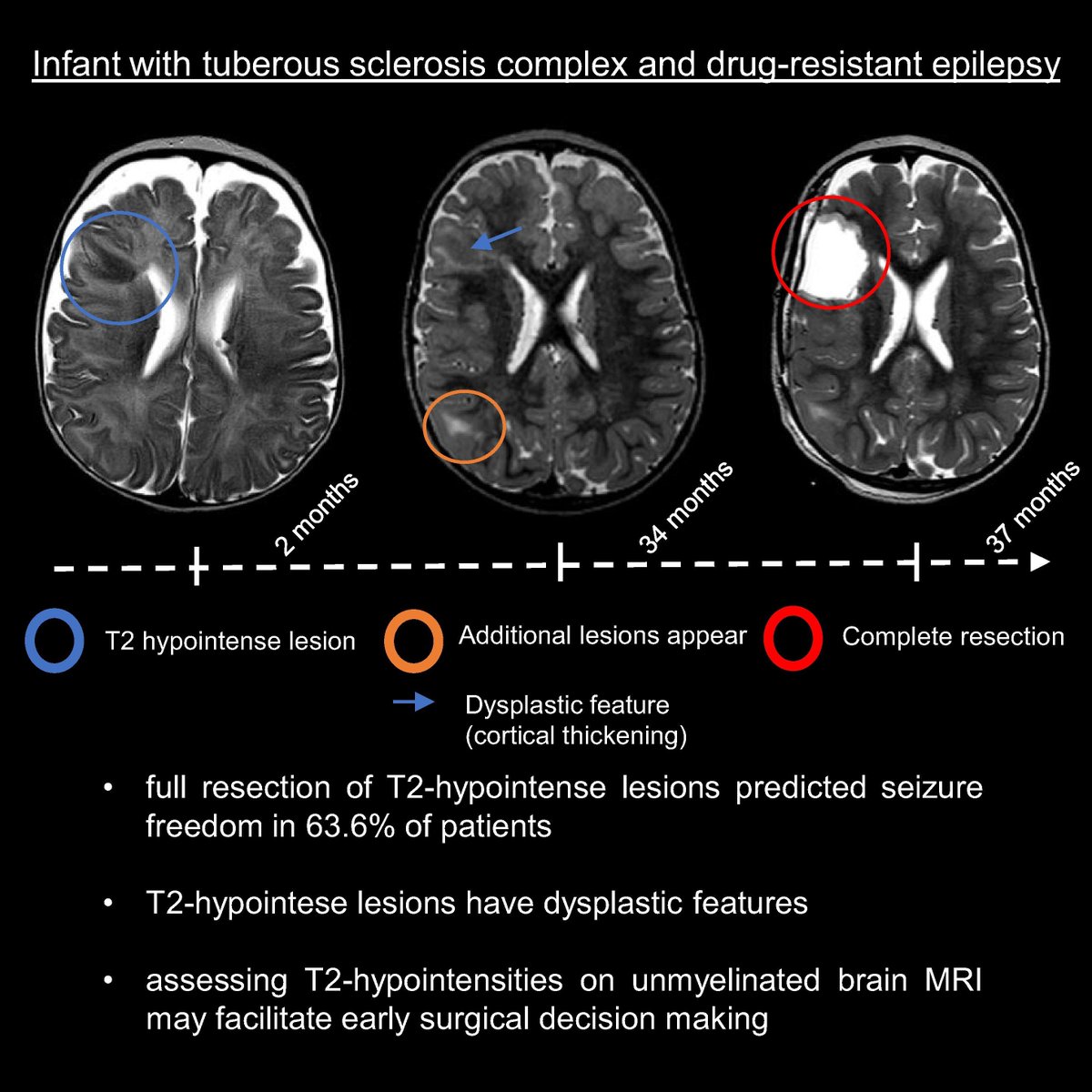 braincomms's tweet image. Ebel and Stevering et al. find significant diagnostic value from T2-hypointensity on unmyelinated brain MRI in identifying epileptogenic lesions in infants with tuberous sclerosis complex (TSC). Read at buff.ly/z9HWtML