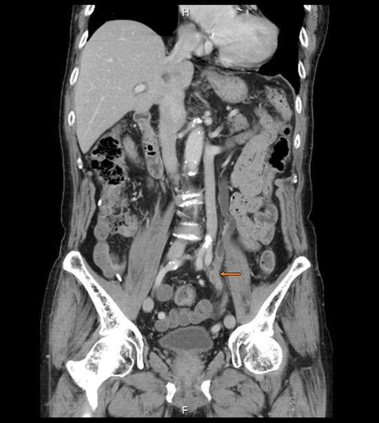 urogoldjournal's tweet image. GOLD CHALLENGE
74M with left hydronephrosis and mid-ureteral wall thickening. Ureteral malignancy suspected, but biopsy shows Congo red-positive deposits. Pathology confirms localized amyloidosis. What’s the best next step?
@NTUH @UrologyJrnl #UroOnc #GoldCaseChallenge…