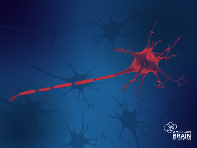 ABFbrain's tweet image. Nerve fibers have a protective coating called myelin. Over time, conditions like multiple sclerosis damage myelin and then the nerve fibers themselves. This week’s blog post explores this process, called #demyelination. 📰 Read the blog ow.ly/rbMt50WpB5i ⬇️
