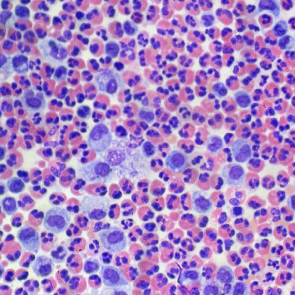 PathologyKate's tweet image. EOSINOPHILS!
Please remember that they’re NOT the expected red/orange on a Pap stain!!