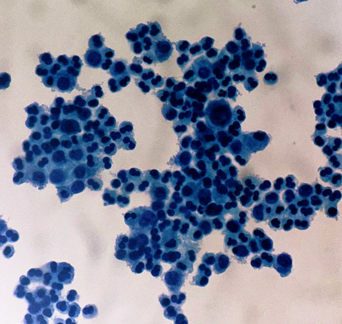 PathologyKate's tweet image. EOSINOPHILS!
Please remember that they’re NOT the expected red/orange on a Pap stain!!